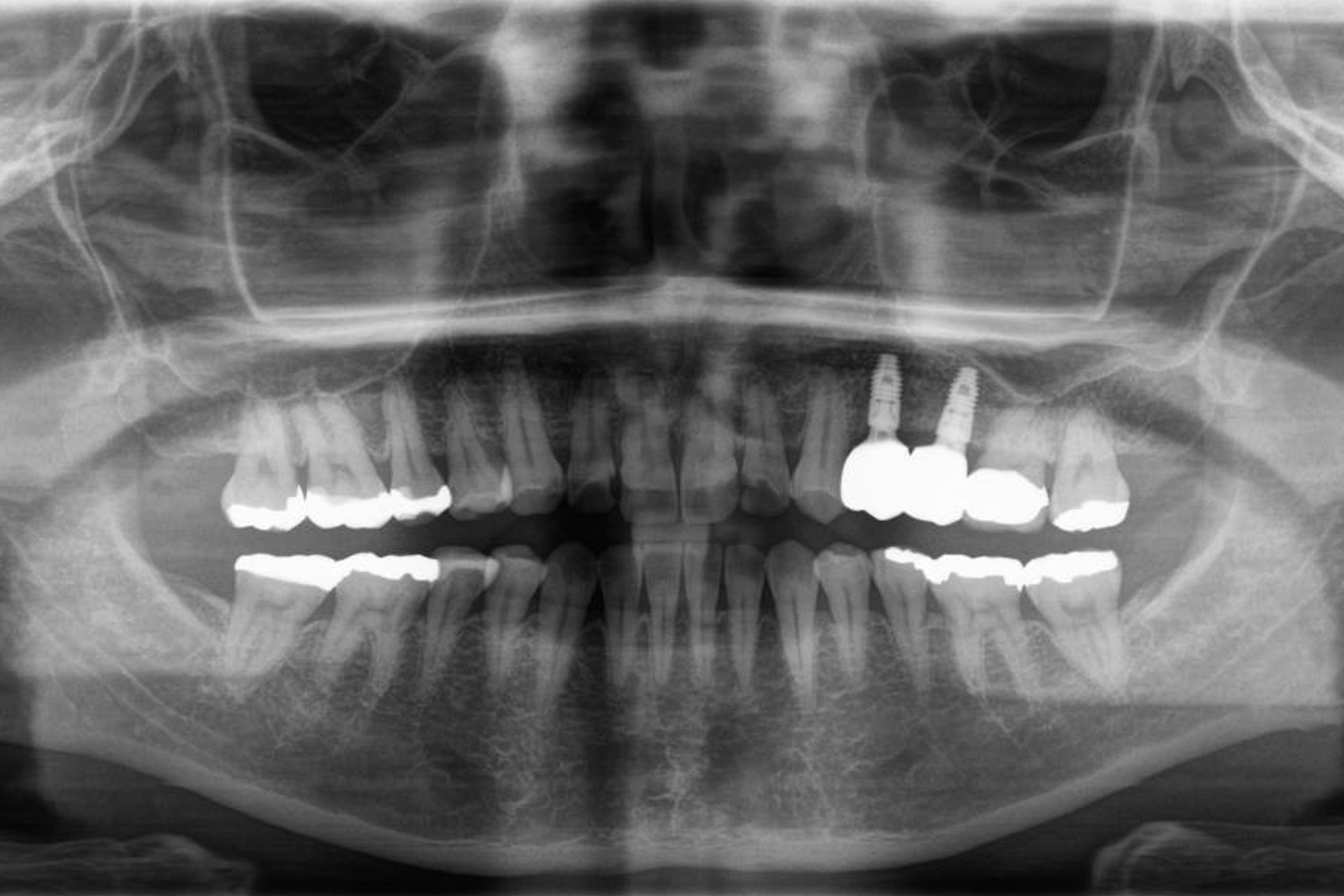 インプラント症例1