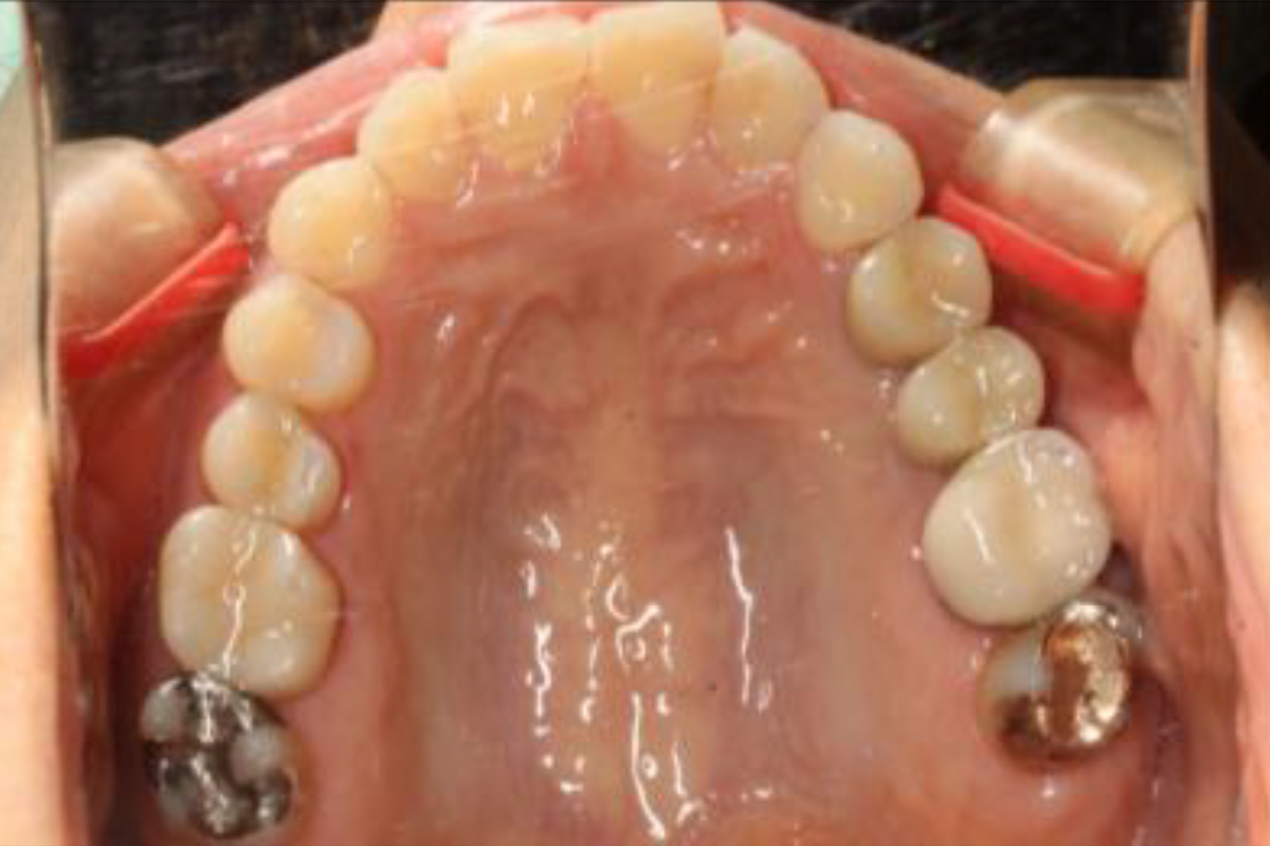 インプラント症例1