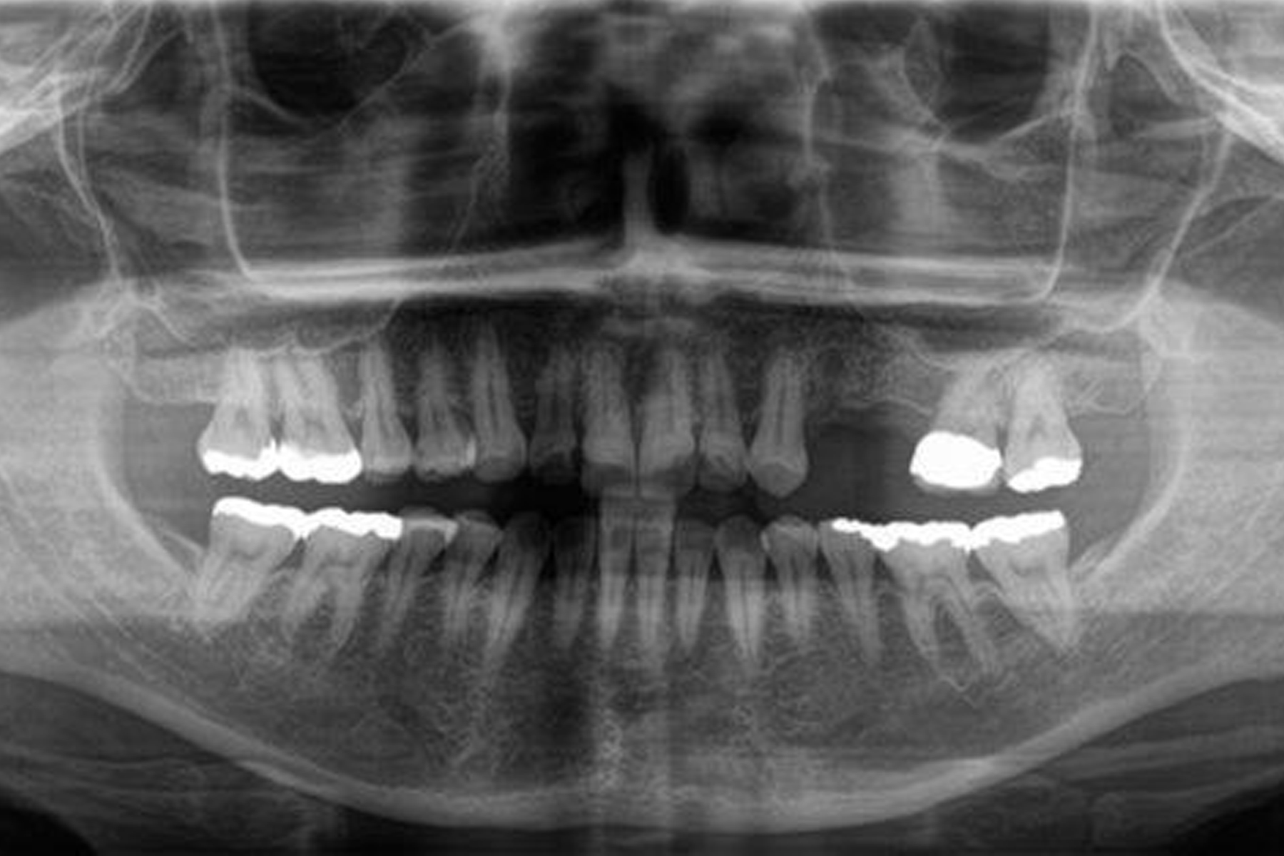 インプラント症例1