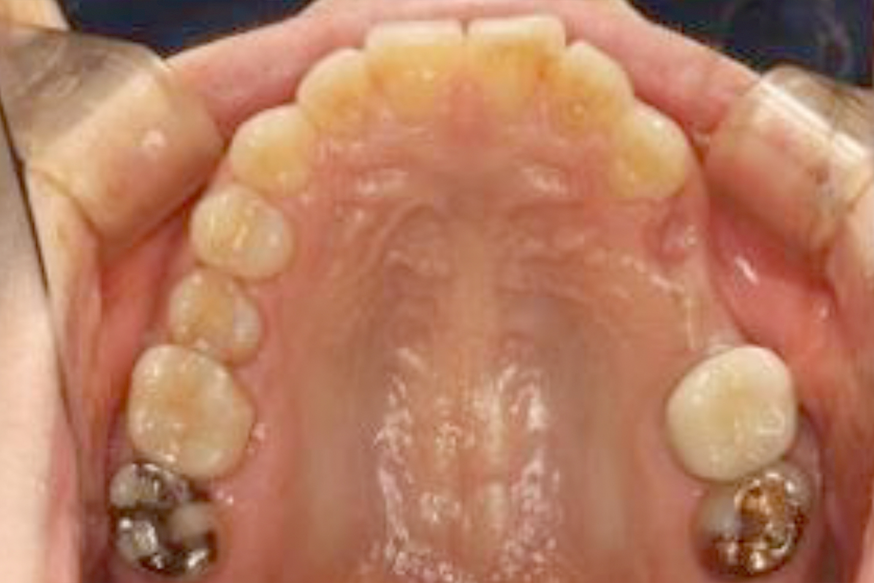 インプラント症例1