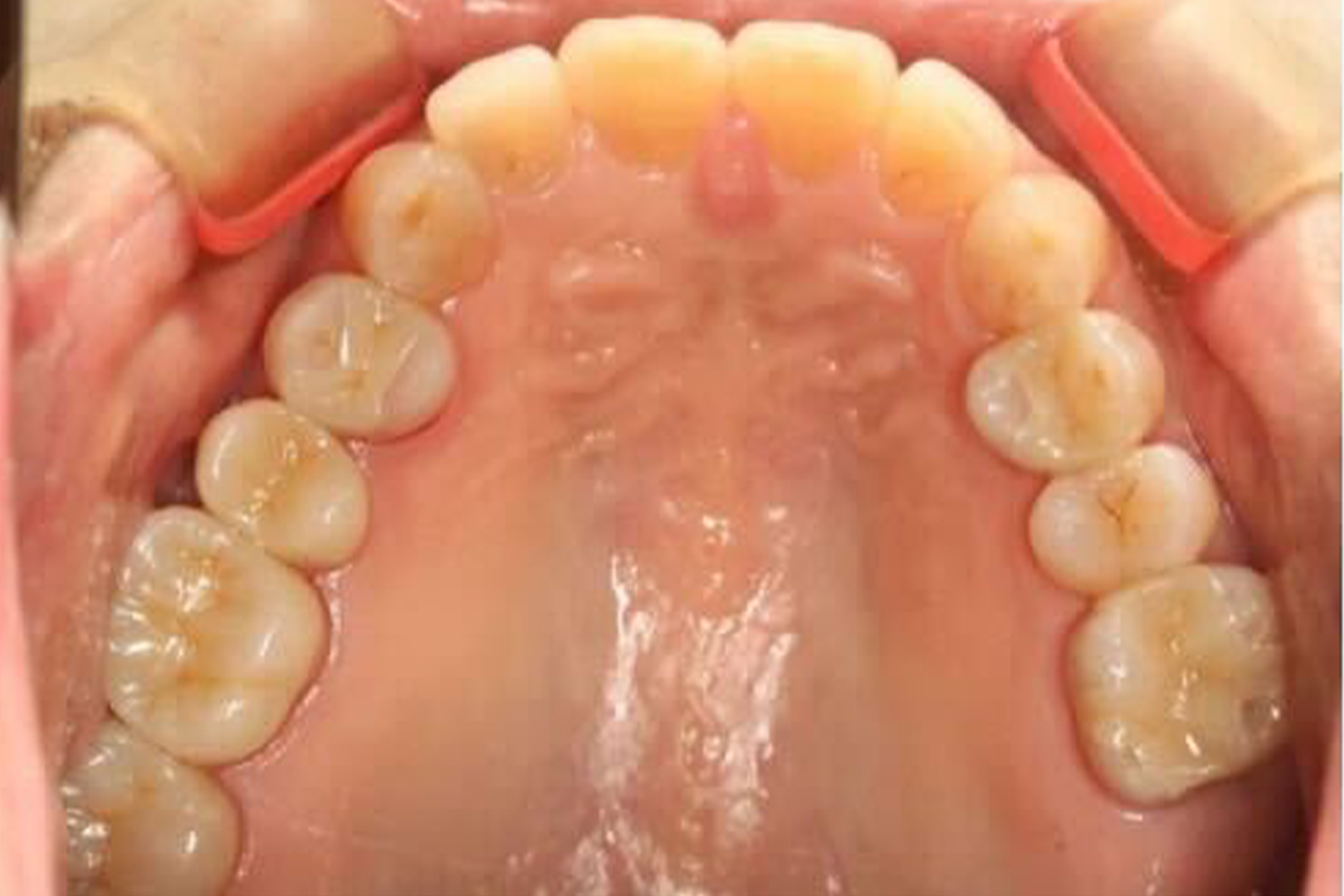 セラミック症例1