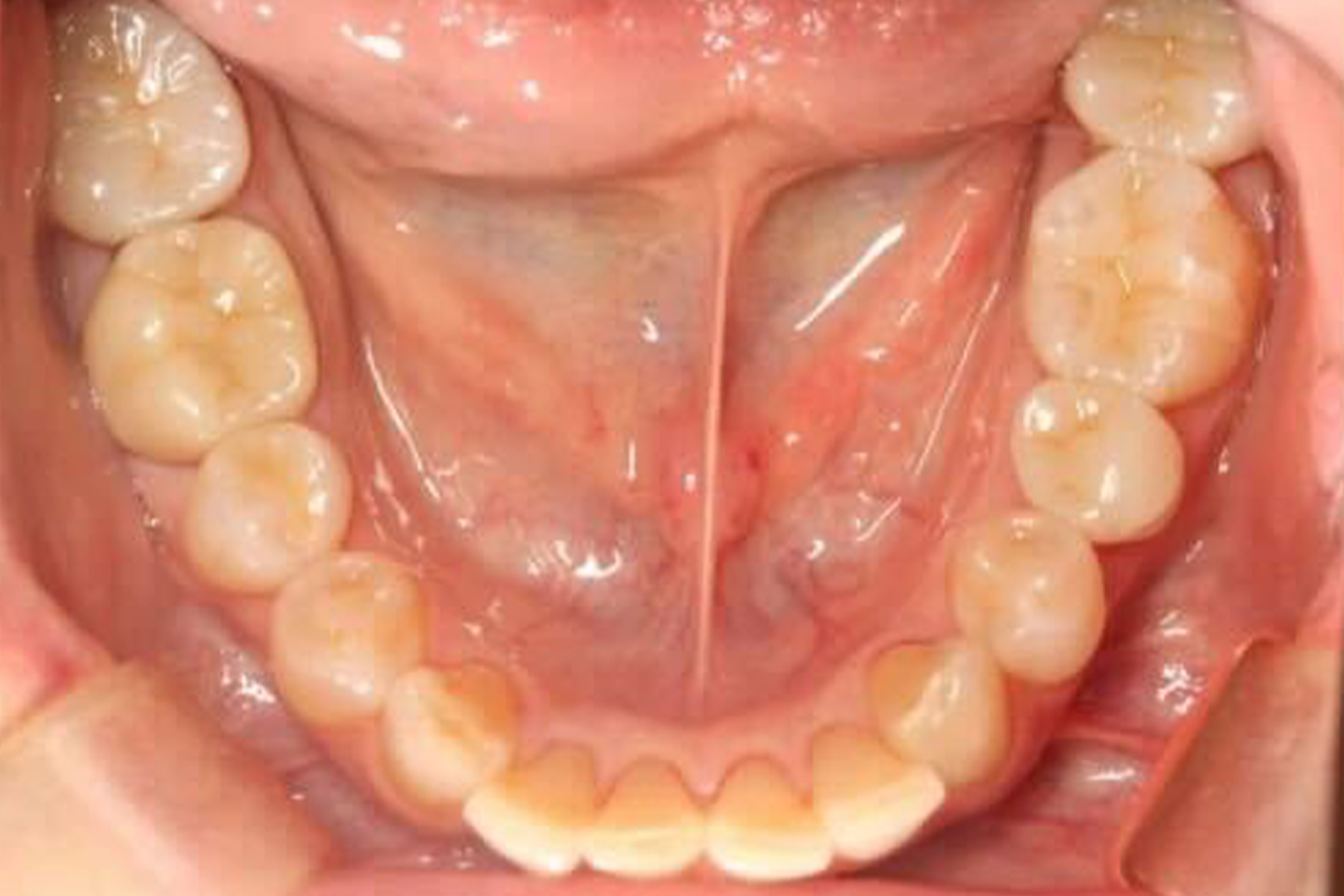 セラミック症例1
