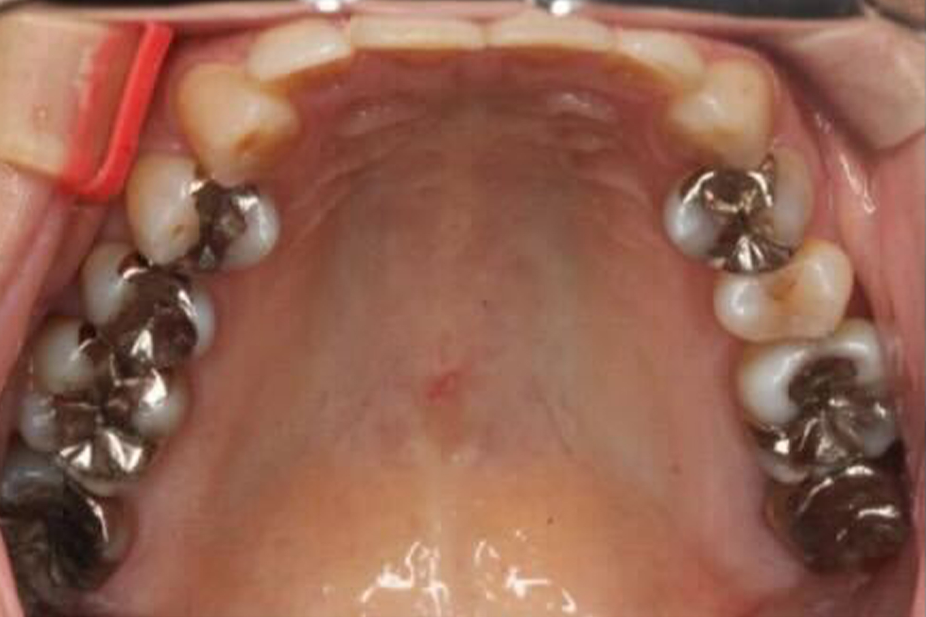 セラミック症例1