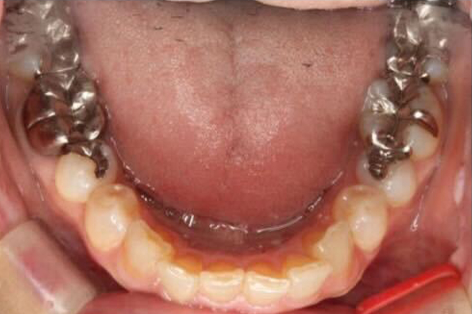 セラミック症例1