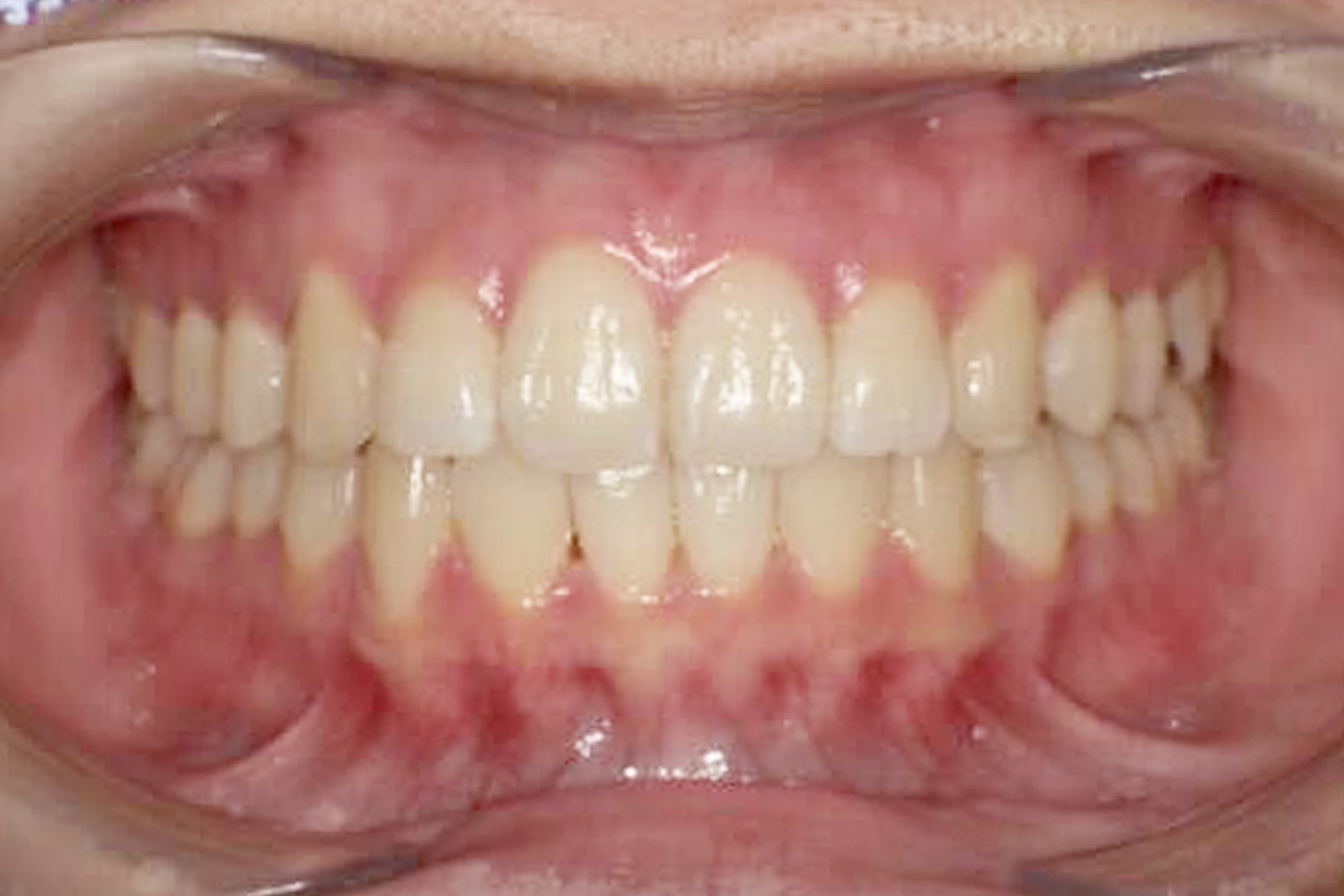 インプラント症例1