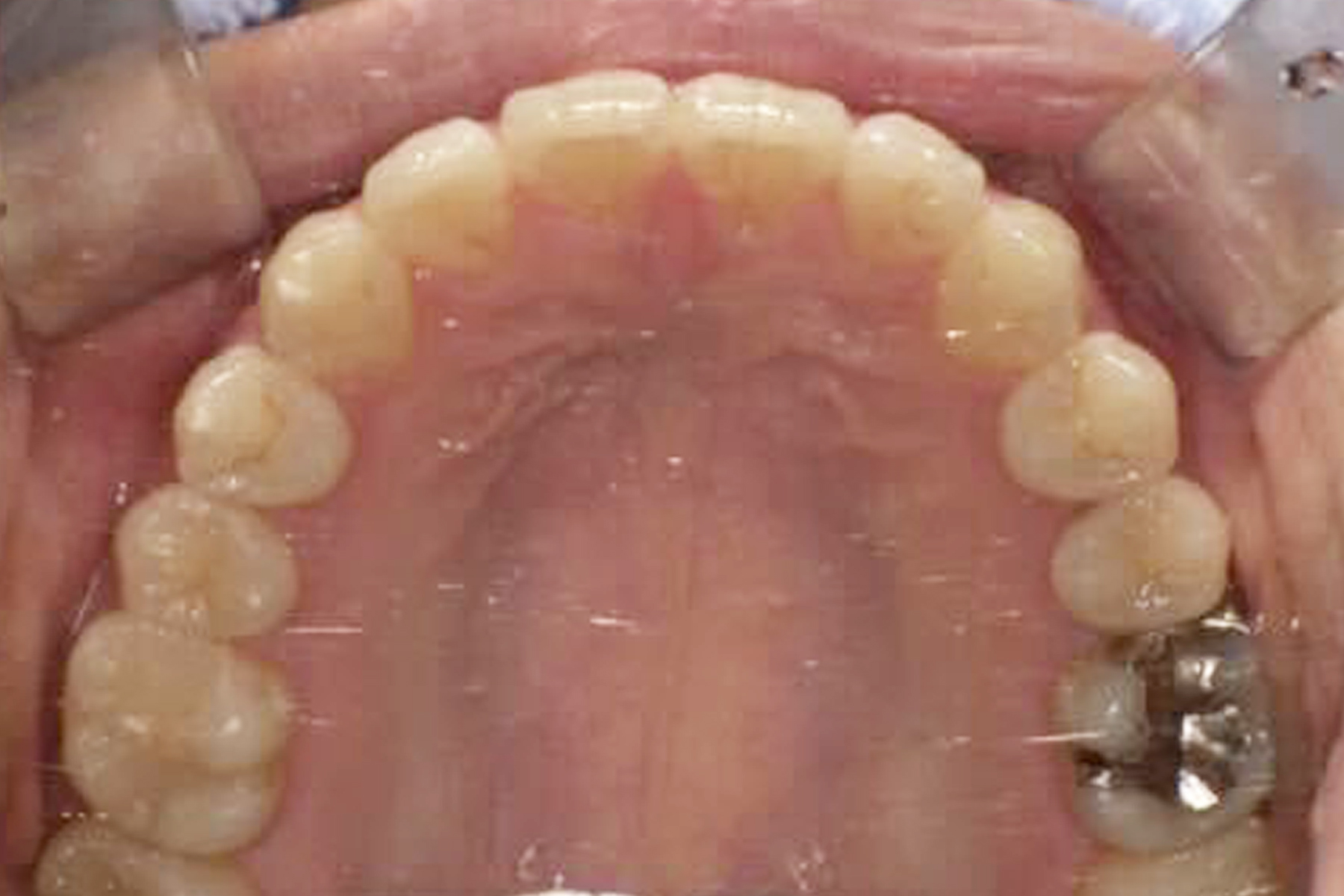 インプラント症例1