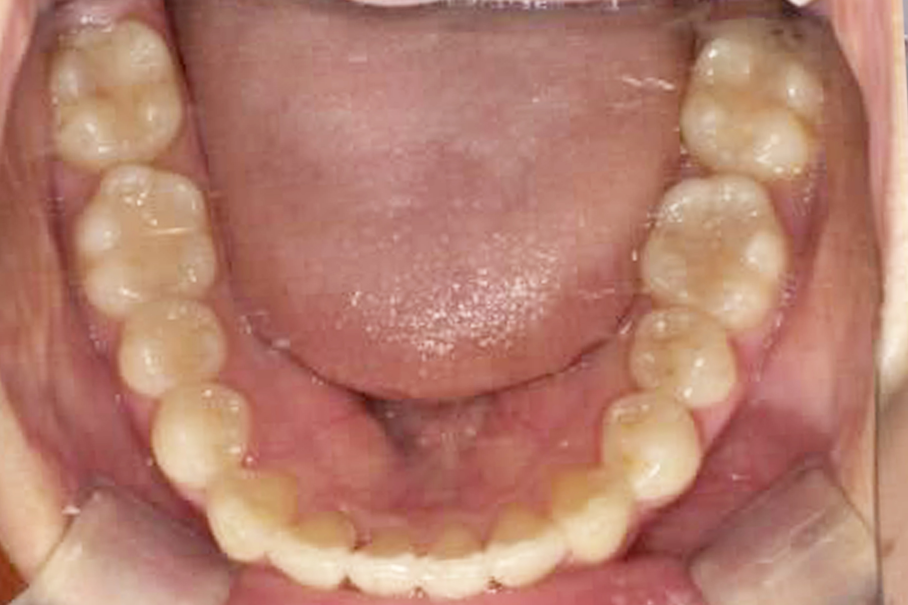 インプラント症例1