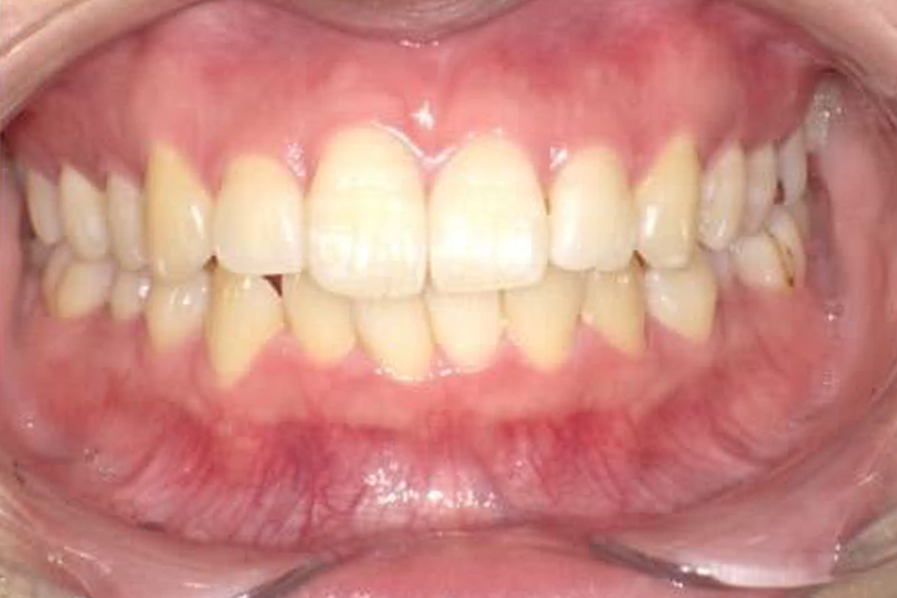 インプラント症例1