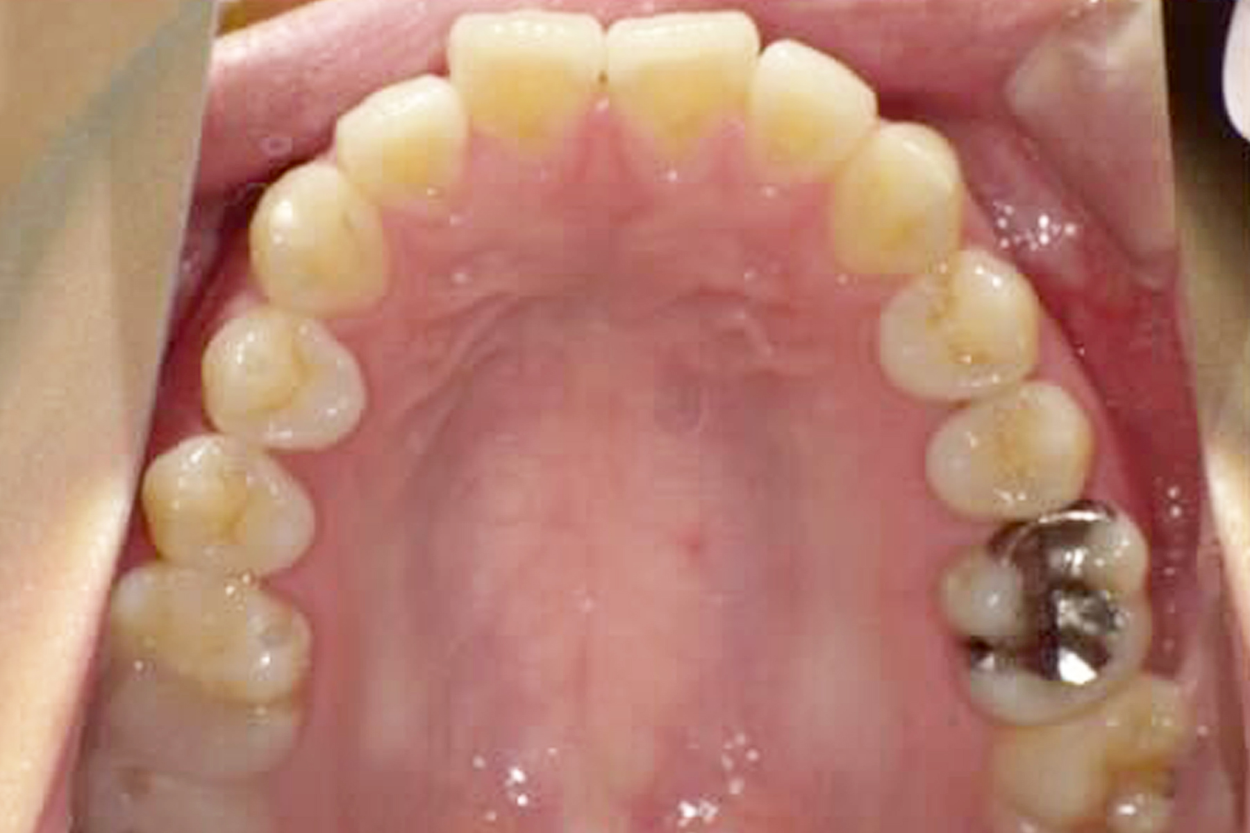 インプラント症例1